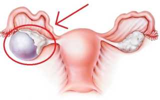 Выделения при кисте яичника