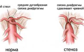 Как распознать и лечить стеноз чревного ствола