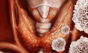 Хронический аутоиммунный тиреоидит