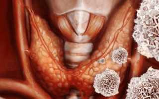 Хронический аутоиммунный тиреоидит