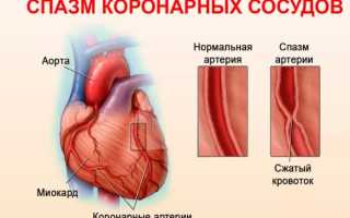 Характер и продолжительность боли после стентирования