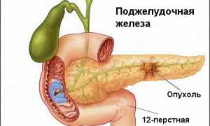 Лечение рака поджелудочной