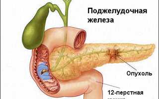 Лечение рака поджелудочной