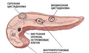 Киста на поджелудочной железе: причины и лечение