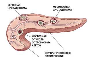 Киста на поджелудочной железе: причины и лечение