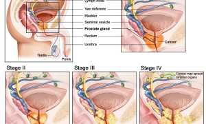 Операция по удалению аденомы простаты