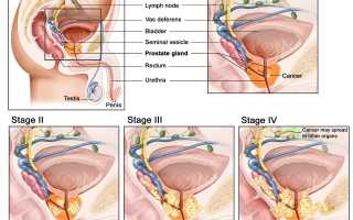 Операция по удалению аденомы простаты