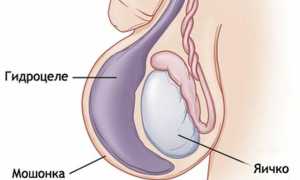 Как вылечить водянку яичка без операции