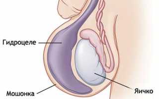 Как вылечить водянку яичка без операции