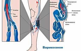 Как избавиться от боли при варикозе