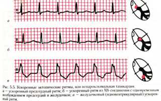 В чем причина возникновения эктопического ритма у человека