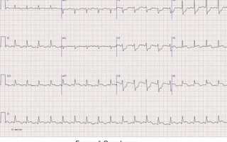 Как проявляется инфаркт миокарда на ЭКГ