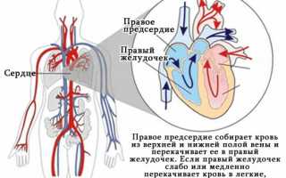 Как проявляется острая сердечная недостаточность