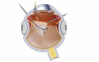 Варианты проведения операции на сетчатке глаза
