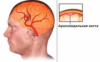 Опасная арахноидальная ликворная киста: сложно выявить, еще сложнее удалить