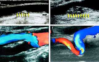 Результативное дуплексное сканирование головы и шеи: все, что нужно знать