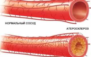 Причины, симптомы и лечение закупорки сосудов ног