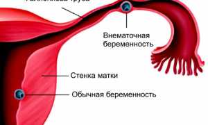 Внематочная беременность на УЗИ