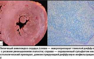 Почему возникает и как лечится дисметаболическая миокардиодистрофия