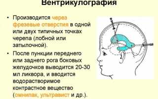 Исследование вентрикулография сердца и головы: показания, возможные осложнения