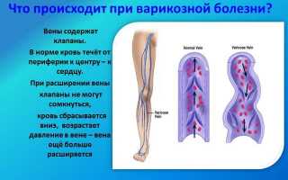 Допустимые физические нагрузки при варикозе