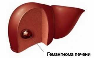 Лучшие варианты лечения гемангиомы