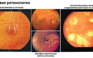 Болезнь, приводящая к слепоте — фоновая ретинопатия