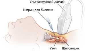 Биопсия щитовидной железы