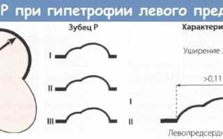 Причины развития гипертрофии левого предсердия, симптомы и восстановление