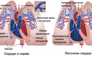 Как проявляется и лечится легочная гипертензия у детей