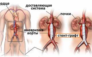 Причины возникновения и методы лечения атеросклероза брюшного отдела аорты