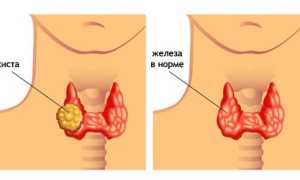 Киста в щитовидной железы