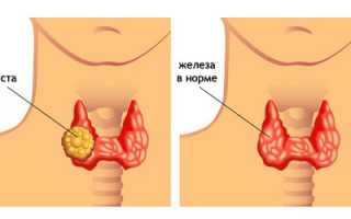 Киста в щитовидной железы