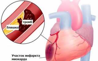 Лечение в стационаре при инфаркте миокарда