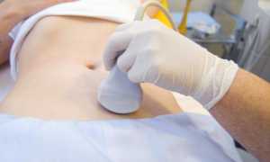 Киста желтого тела яичника