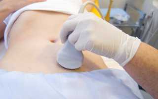 Киста желтого тела яичника