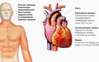 Сестринский уход: проблемы пациента при инфаркте миокарда