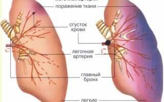 Смертельная угроза, которая приходит из пустяка — гнойный тромбофлебит