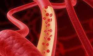 Диабетическая ангиопатия нижних конечностей