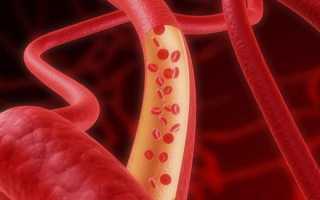 Диабетическая ангиопатия нижних конечностей