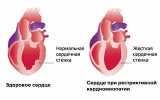 Сложное заболевание будущей мамы — кардиомиопатия беременных