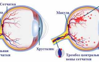 Изменения в сосудах, которые могут привести к слепоте — атеросклероз сетчатки