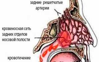 Как остановить кровь из носа при скачке давления