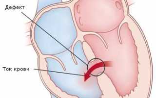 Развитие дефекта межжелудочковой перегородки, методика ведения и лечения пациентов