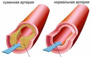 Доступные и эффективные таблетки от холестерина, а также новые разработки