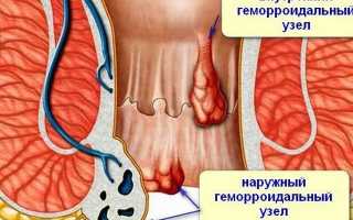 Сравнительно безопасные и эффективные свечи Проктозан: применение, стоимость, аналоги