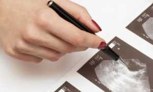 Киста яичника на УЗИ