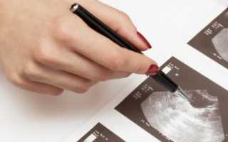 Киста яичника на УЗИ