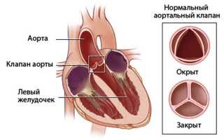 Насколько опасна недостаточность клапанов сердца