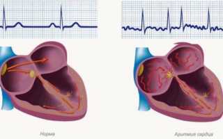 Как влияет тиреотоксикоз на сердце